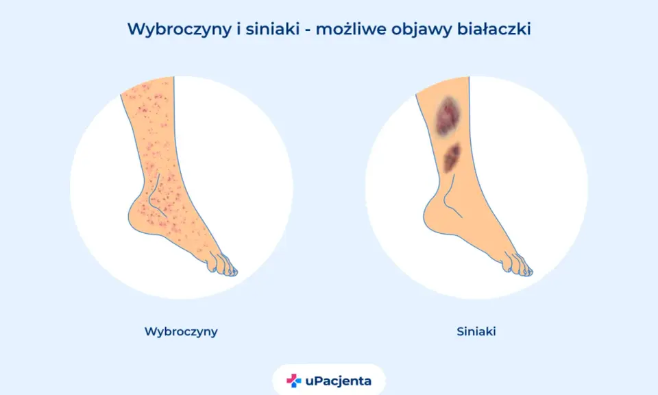 Wybroczyny i siniaki na nogach mogą być objawami białaczki szpikowej. Ilustracja pokazuje zmiany skórne.