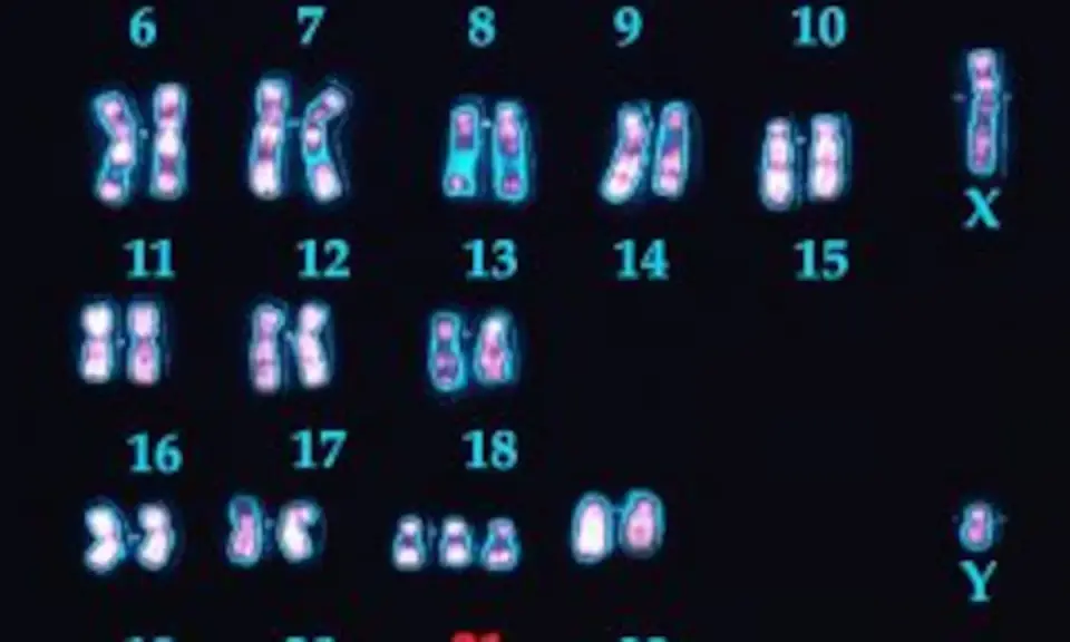 Cariotipo humano con 23 pares de cromosomas, incluyendo el par sexual X e Y. Se observan los cromosomas del 6 al 18, y el 21.