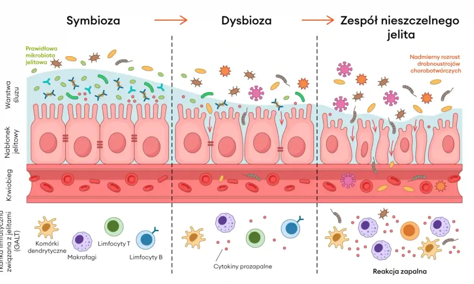 Ilustracja pokazuje, co to jest immunologia jelitowa: od symbiozy, przez dysbiozę, po zespół nieszczelnego jelita i reakcję zapalną.