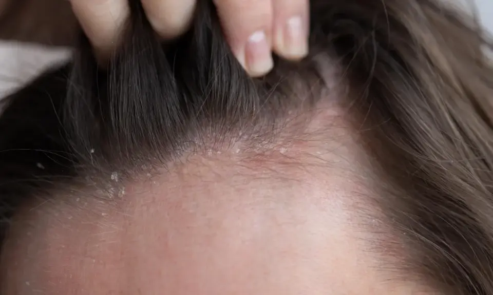 Une main soulève des mèches de cheveux, révélant des pellicules sur le cuir chevelu. Une pellicule enfant peut être une préoccupation pour les parents.