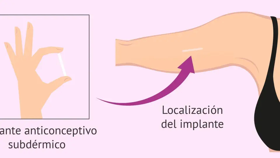 Mano sostiene implante anticonceptivo subdérmico. Flecha indica localización del implante en el brazo.