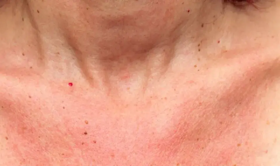 Peau rougie et tachetée sur le décolleté, avec une petite cicatrice soleil rouge vif.