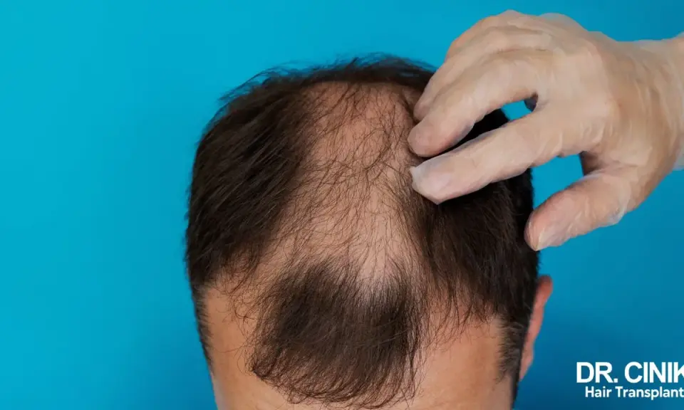 Main d'un médecin examinant une perte de cheveux. Une solution pour la perte de cheveux due à la thyroïde.