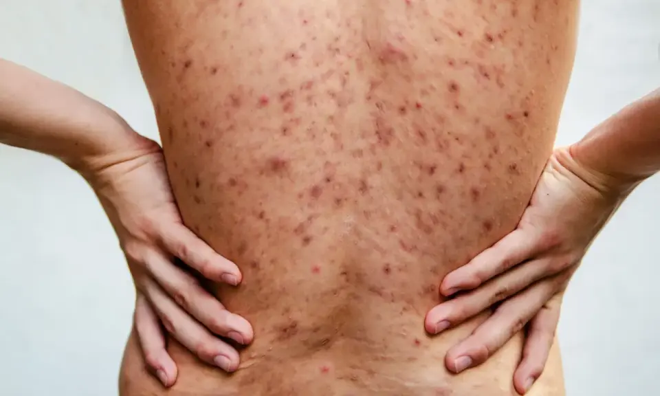 Plecy pokryte licznymi, czerwonymi i ciemnymi zmianami skórnymi, wskazującymi na trądzik piorunujący. Dłonie opierają się na biodrach.