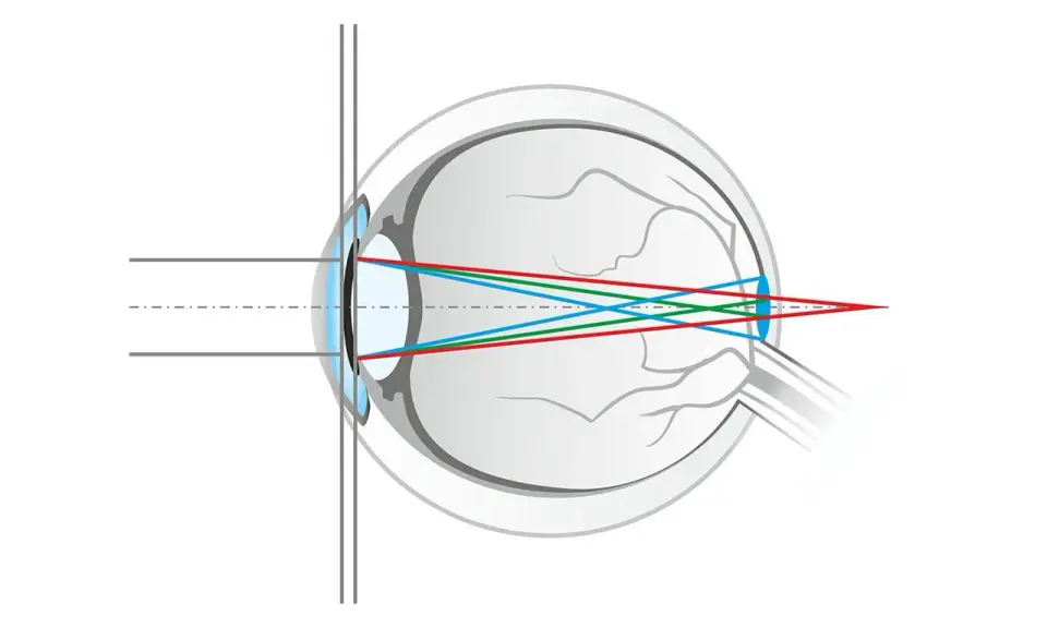 Schéma de l'œil montrant la réfraction des rayons lumineux rouge, vert et bleu. La lumière bleue est plus déviée, illustrant qu'est ce que la lumière bleue.