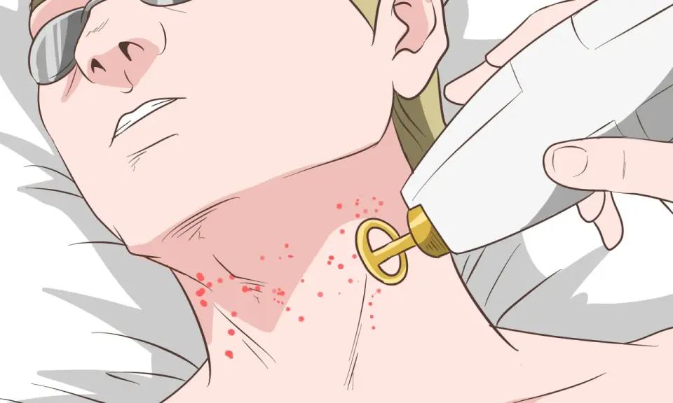 Persona con gafas protectoras recibe tratamiento láser para el acné en el cuello.