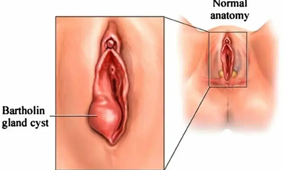 Ilustracja pokazuje zapalenie gruczołu Bartholina jako powiększoną torbiel po lewej stronie, w porównaniu do prawidłowej anatomii po prawej.