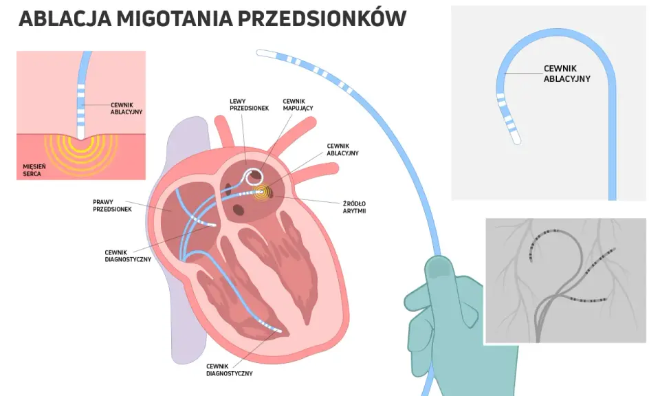 Ablacja migotania przedsionków: cewniki diagnostyczne i ablacyjne docierają do serca, by zlokalizować i zniszczyć źródło arytmii.