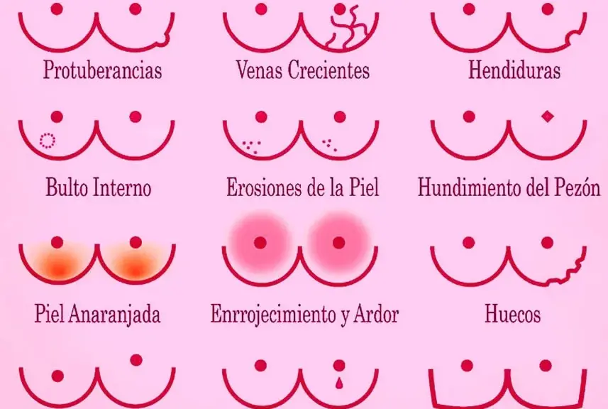 Síntomas cáncer de mama: ¿Qué señales no debes ignorar?