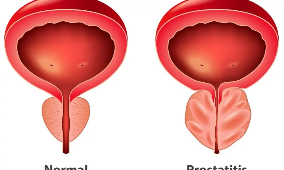 Porównanie prawidłowej i powiększonej prostaty. Zmiany w prostacie mogą objawiać się różnymi objawami.