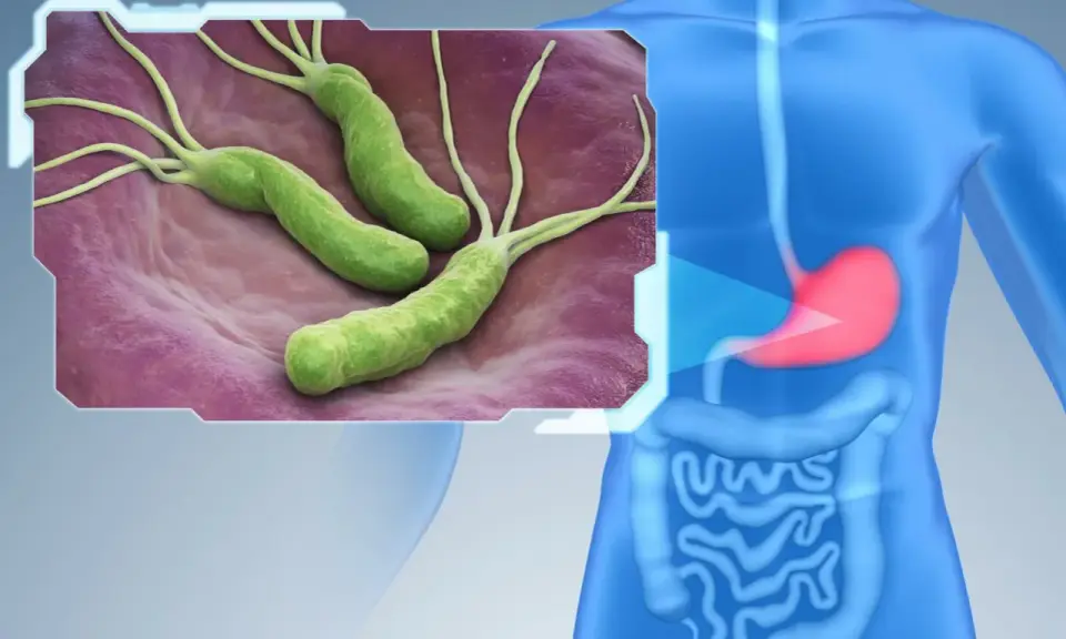 Bakterie Helicobacter pylori w żołądku. Dowiedz się, jak wyleczyć helicobacter.