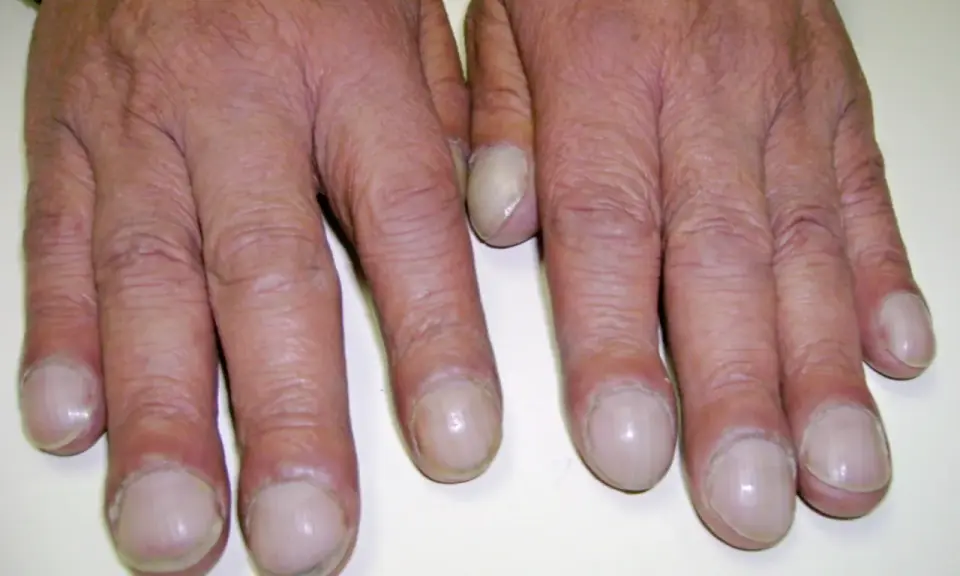 Dita gonfie e unghie arrotondate, segni che possono indicare fibrosi cistica alle mani.