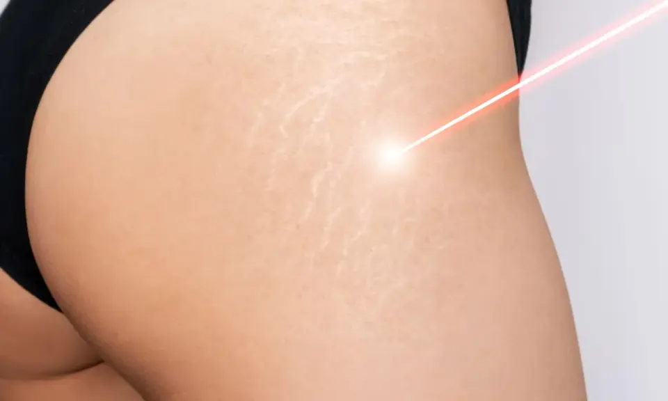 Laser treatment on skin with smagliature, showing a path to come eliminare le smagliature.