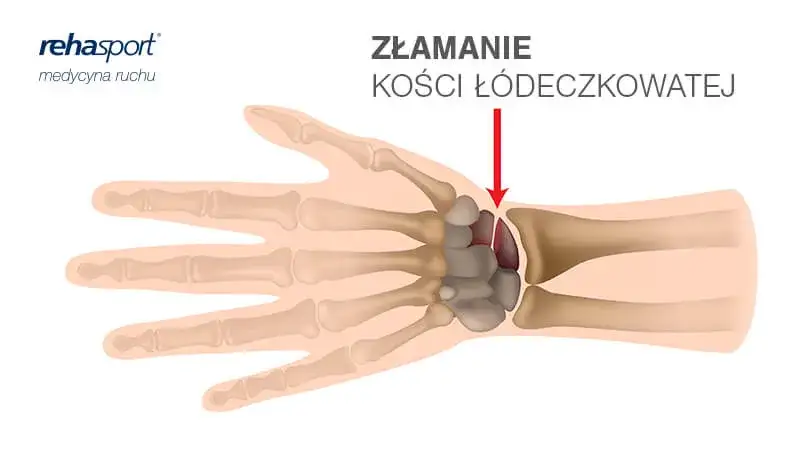 Boli nadgarstek? Skręcenie czy złamanie? Rozpoznaj i pomóż sobie