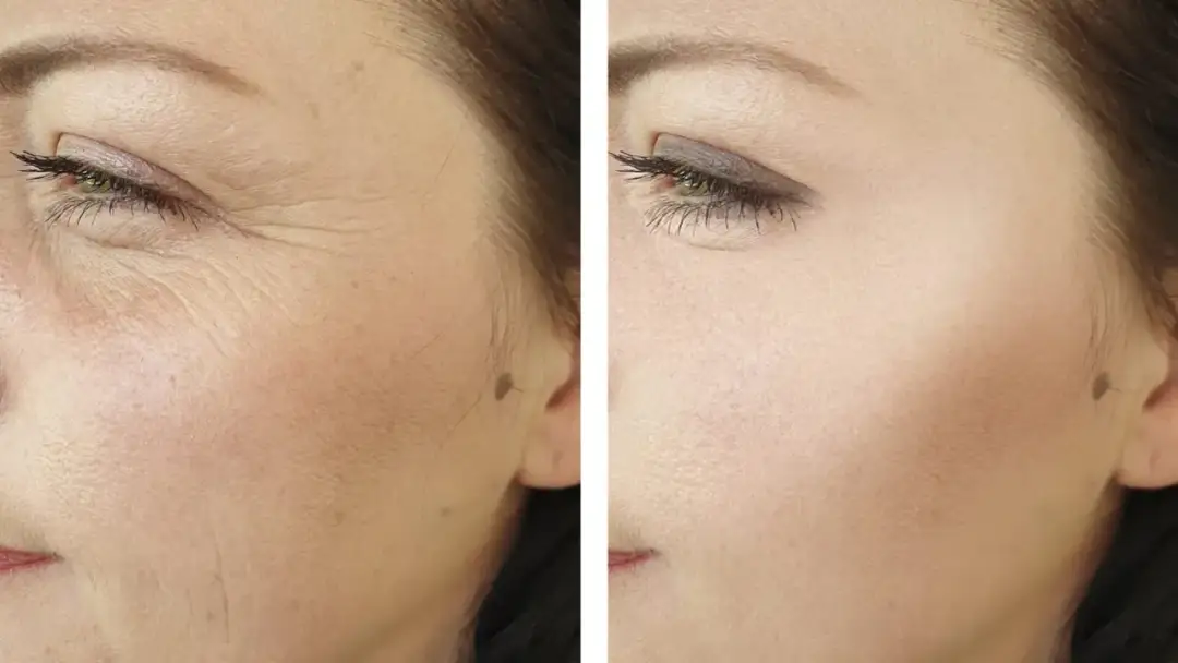 Radiofrecuencia facial - Firmeza sin cirugía, resultados y precios