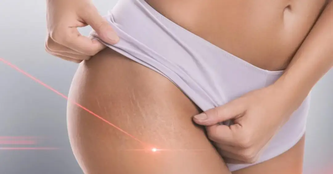 Czerwony promień lasera skierowany na rozstępy na skórze uda, symbolizujący laserowe usuwanie rozstępów.