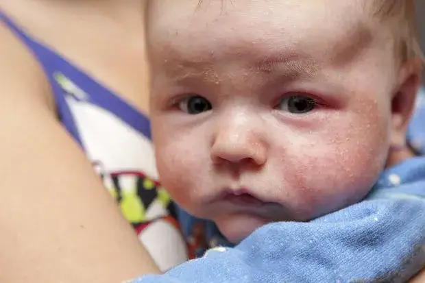 Jak wygląda alergia u niemowlaka? Objawy, które musisz znać