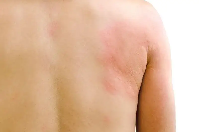 Objawy tocznia rumieniowatego: poznaj pierwsze niepokojące symptomy choroby