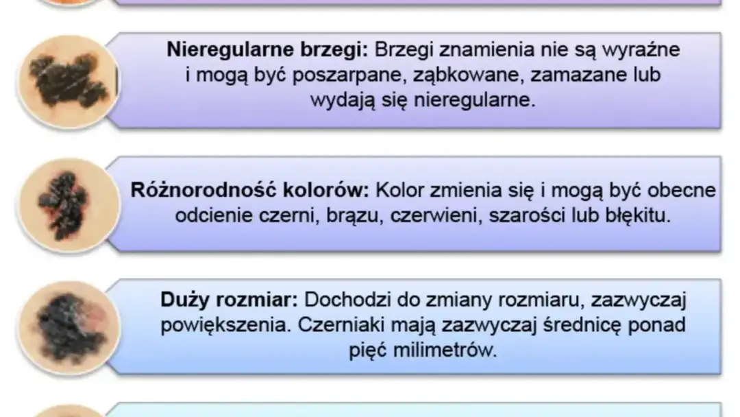 Czerniak - jak rozpoznać objawy i odróżnić go od zwykłego znamienia?