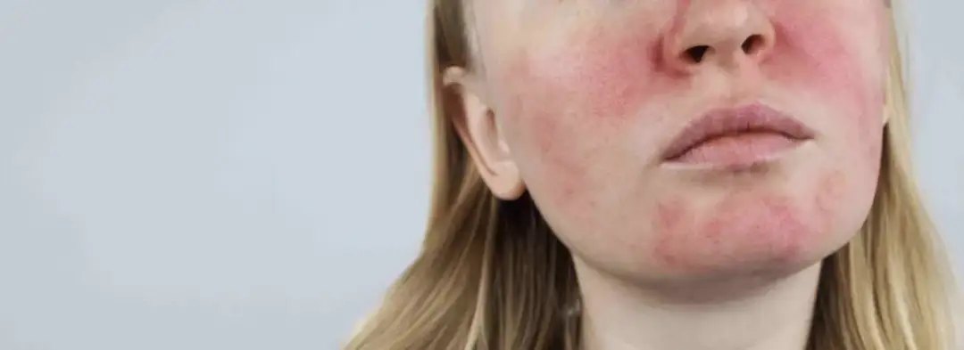 Jak zaradzić problemowi z Trądzikiem różowatym za pomocą Totalnej Biologii