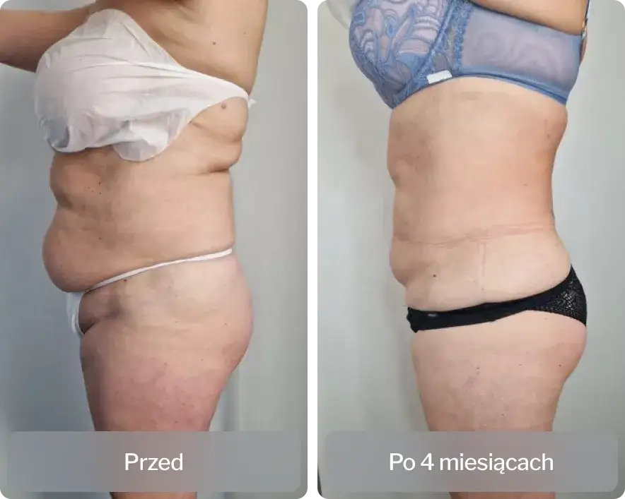 Liposukcja: Co to jest? Pełny przewodnik po zabiegu.