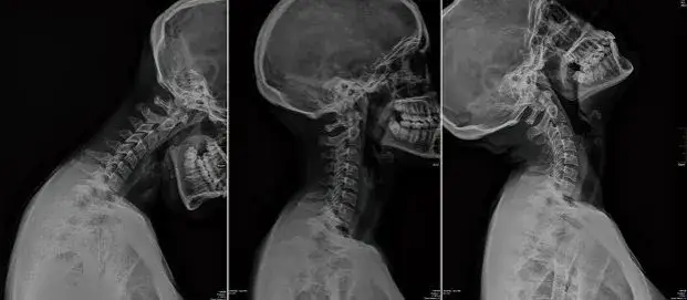 Skręcenie kręgosłupa szyjnego – ile zwolnienia i co warto wiedzieć