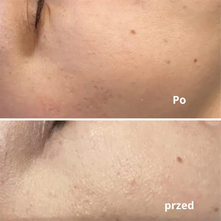 Kiedy makijaż po laserze frakcyjnym? Bezpieczne terminy i zasady