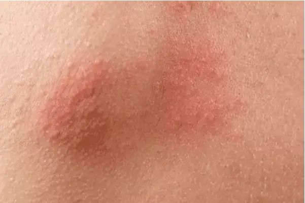 Uczulenie na perfumy: jak rozpoznać objawy i uniknąć reakcji alergicznych