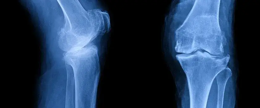 Osteofitoza jaka rehabilitacja: skuteczne metody łagodzenia bólu stawów