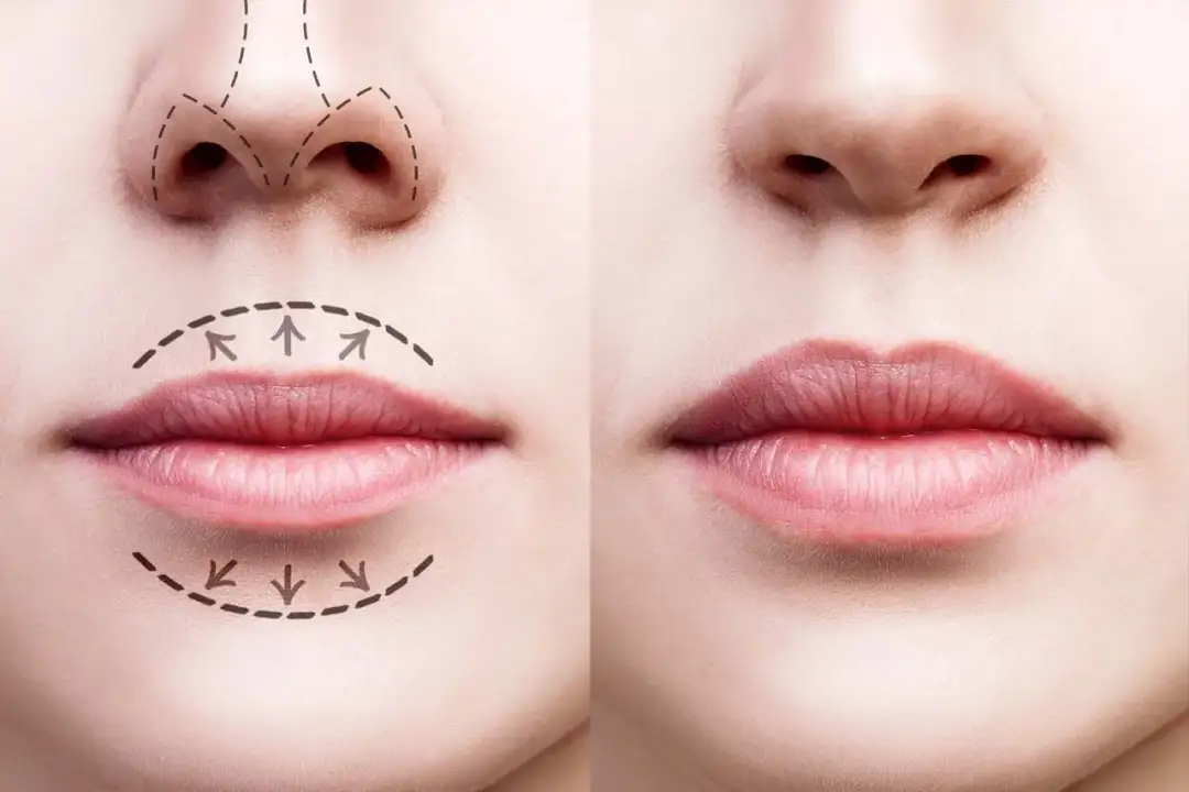 Labios con ácido hialurónico - Guía de resultados, técnicas y precios
