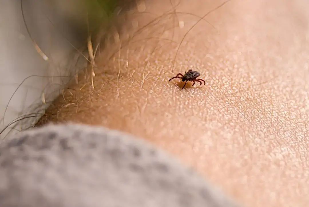 Jak wyjąć kleszcza u człowieka - bezpieczne metody i porady