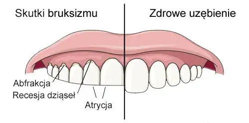 Co oznacza zgrzytanie zębami przez sen i jak temu zapobiec