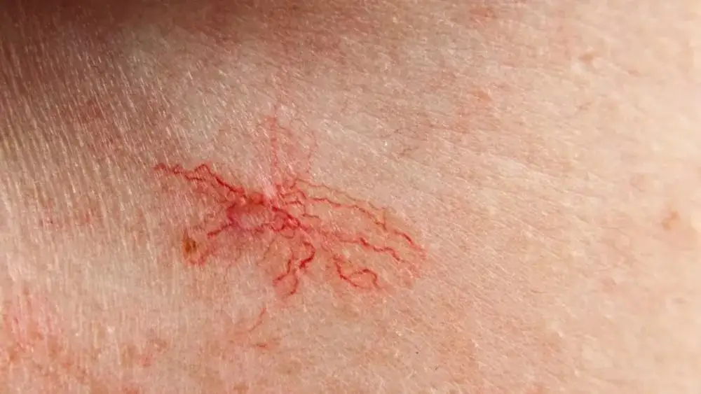Jak wygląda cera naczynkowa? Objawy, cechy i skuteczne porady