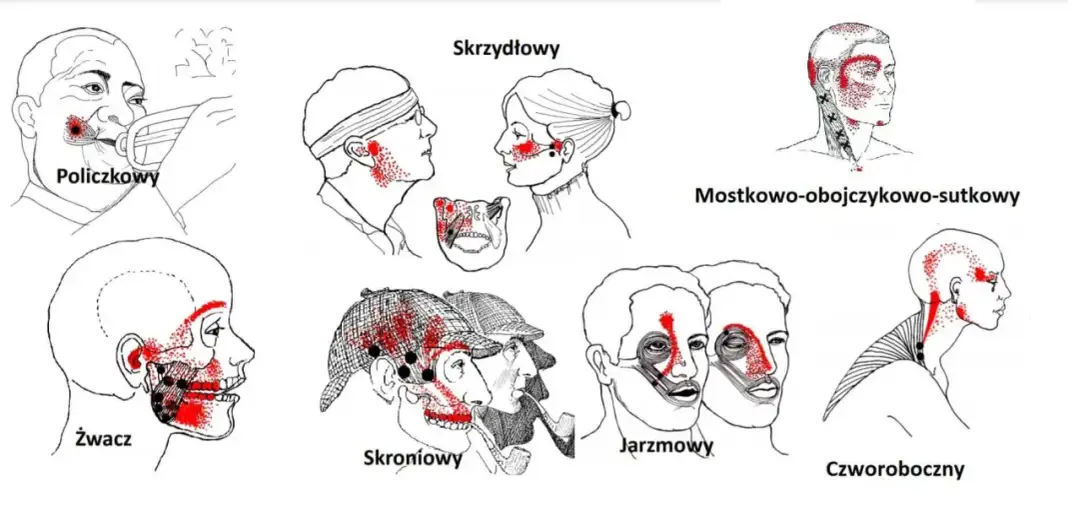 Mięsień skrzydłowy przyśrodkowy - Cichy winowajca bólu szczęki i głowy