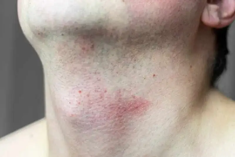 Dlaczego po goleniu mam czerwone kropki i jak ich uniknąć?