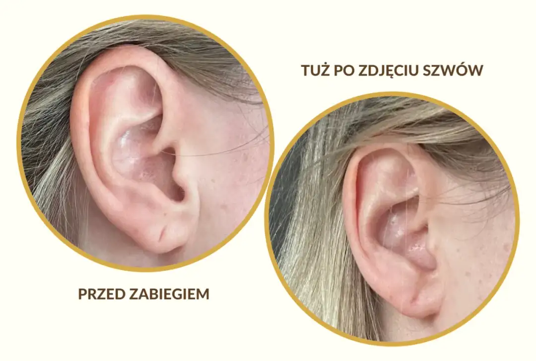 Ucho przed i po zabiegu. Widoczna druga dziurka w uchu, która została poprawiona.