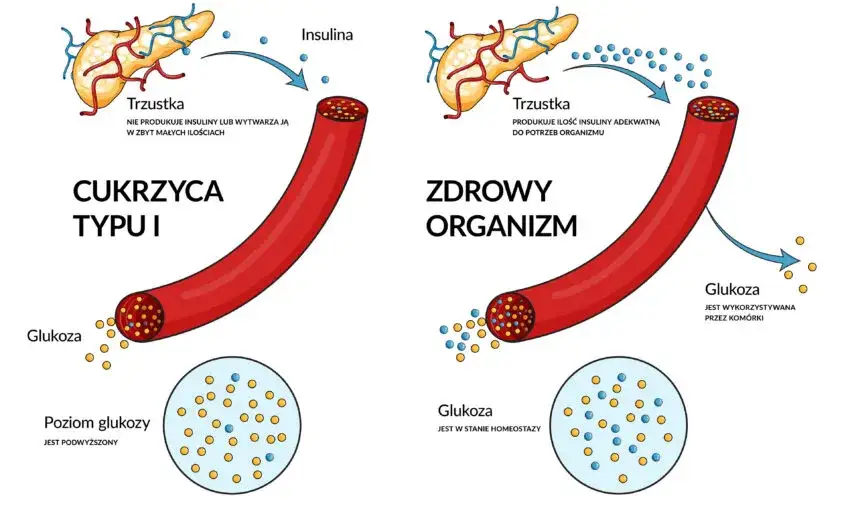 Skąd się bierze cukrzyca? Poznaj zaskakujące przyczyny i czynniki ryzyka