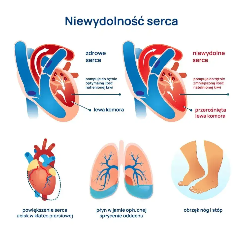 Niewydolność serca objawy: co musisz wiedzieć o duszności i zmęczeniu