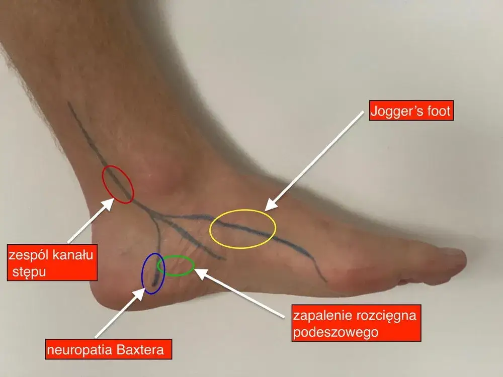 Ból pięty u biegacza jak go pokonać i biegać bez kontuzji?