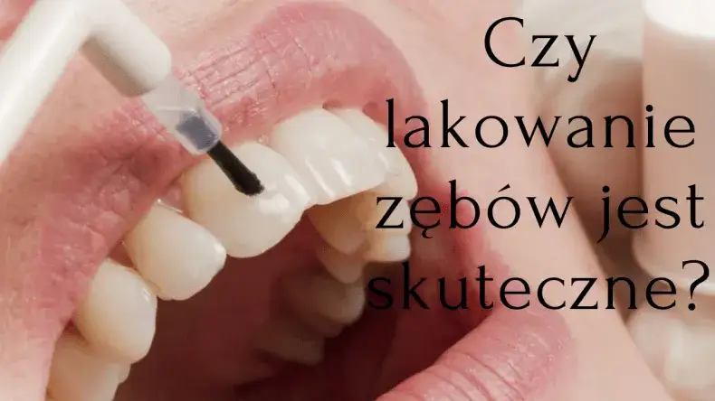 Co to jest lakowanie zębów i jak może uratować Twoje zęby?
