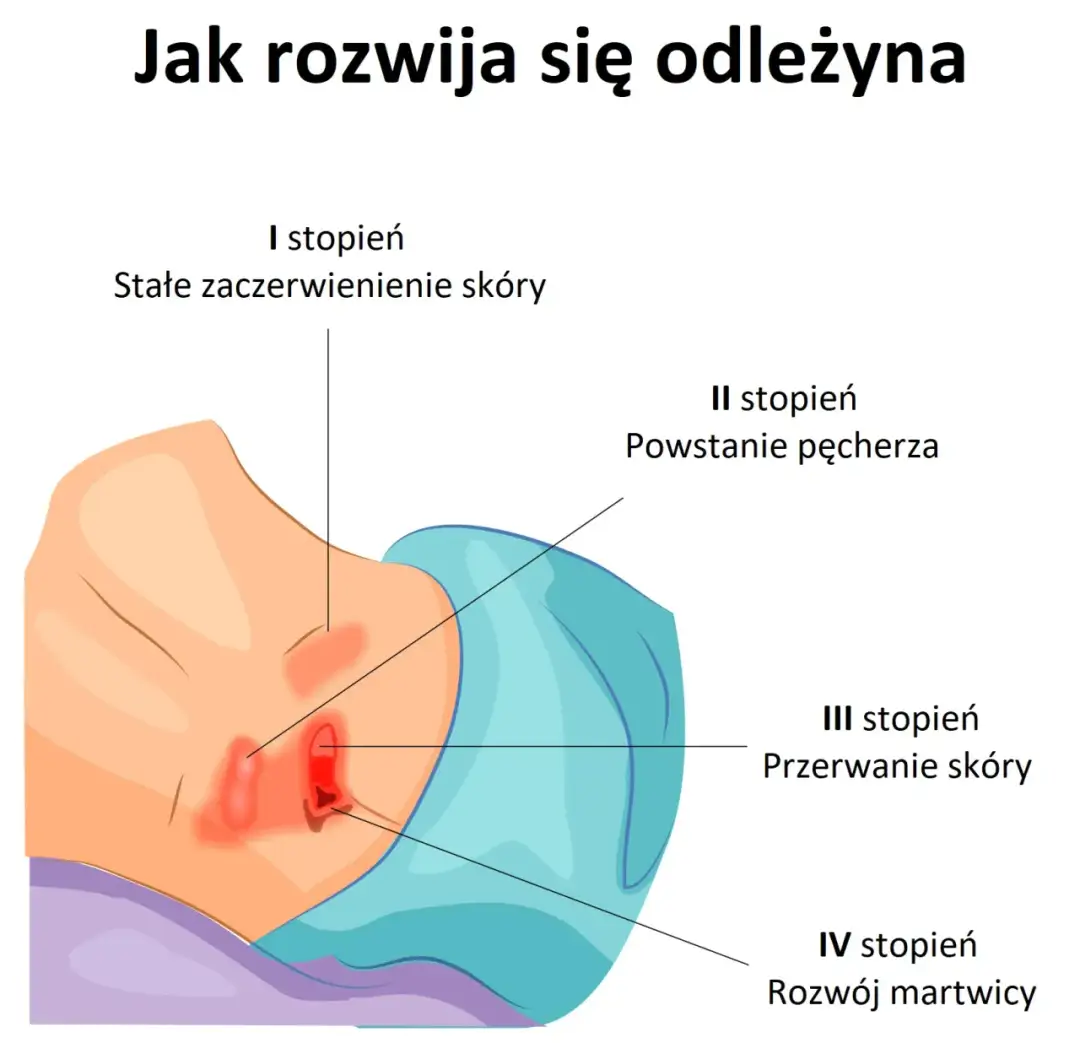 Czy odleżyny prowadzą do śmierci? Poznaj ryzyko powikłań i zapobieganie