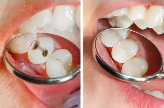 Jak wyleczyć próchnicę bez dentysty? Skuteczne metody i porady