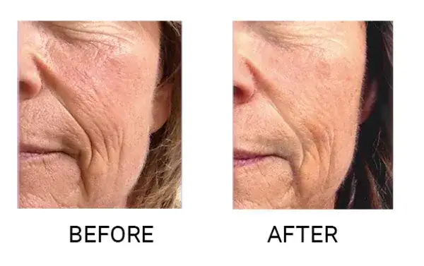 Endermologia twarzy: Naturalny lifting bez skalpela. Efekty, cena.