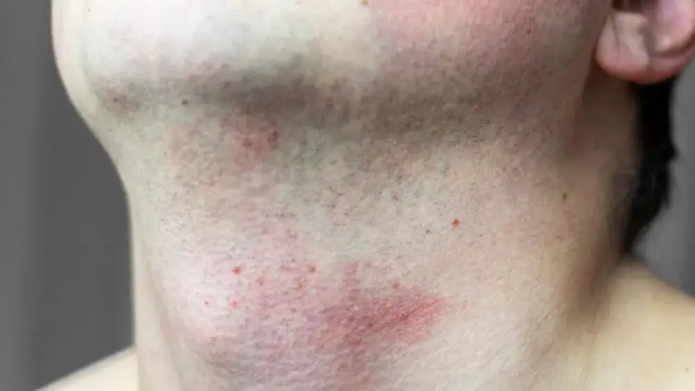 Jak szybko pozbyć się krost po goleniu - skuteczne i proste sposoby