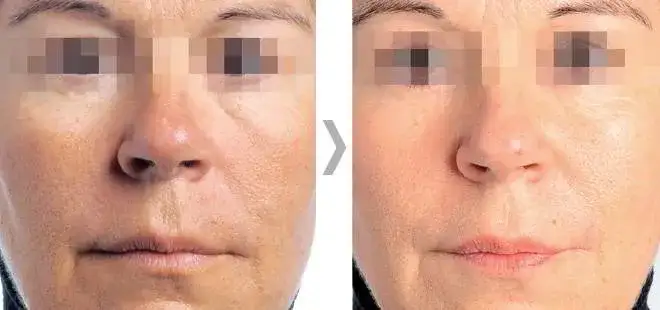 Endermologia twarzy ile zabiegów potrzebujesz, aby uzyskać efekty?