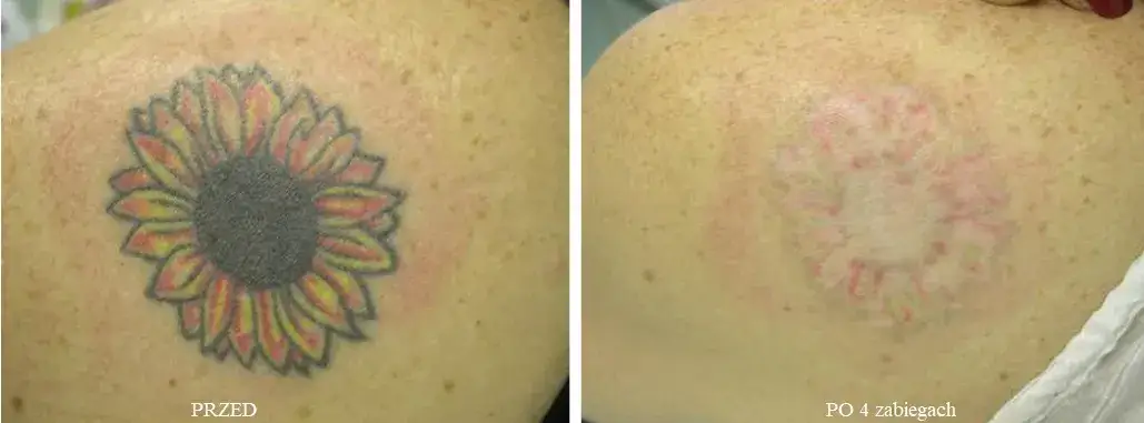 Usuwanie tatuażu Gdańsk: Gdzie bezpiecznie? Ranking gabinetów