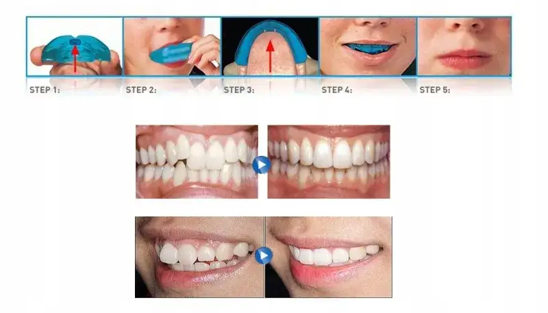 Jak mieć proste zęby bez aparatu? Skuteczne metody i porady