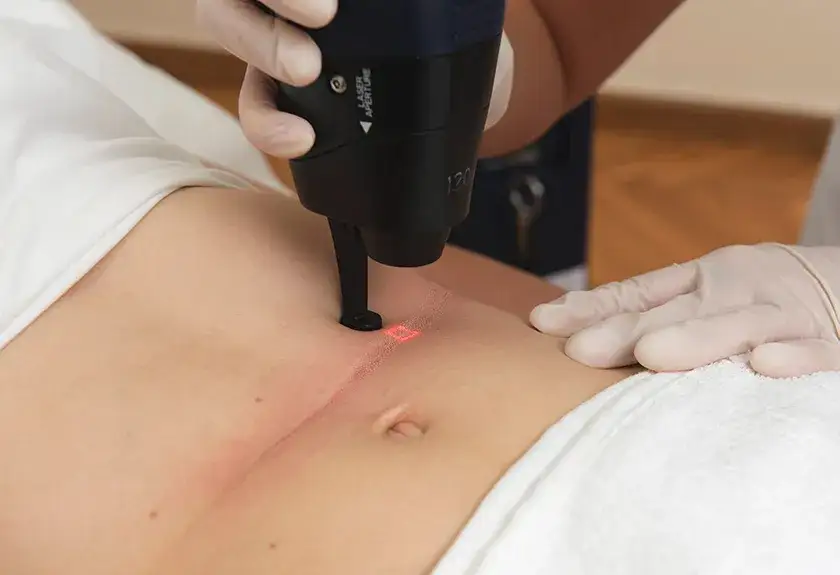 Jak się przygotować do laseru frakcyjnego, aby uniknąć problemów?