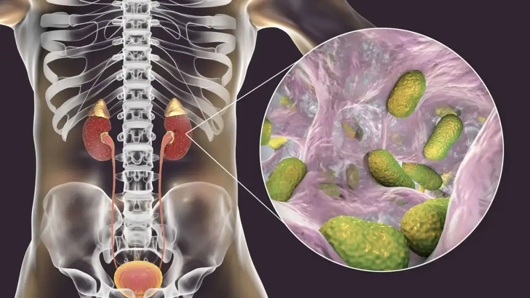 Bóle nerki objawy: Jak rozpoznać niebezpieczne symptomy?