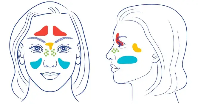 Die häufigsten Symptome einer Nasennebenhöhlenentzündung erkennen